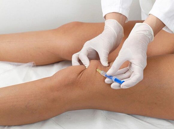 ενδοαρθρική ένεση για αρθροπάθεια γόνατος